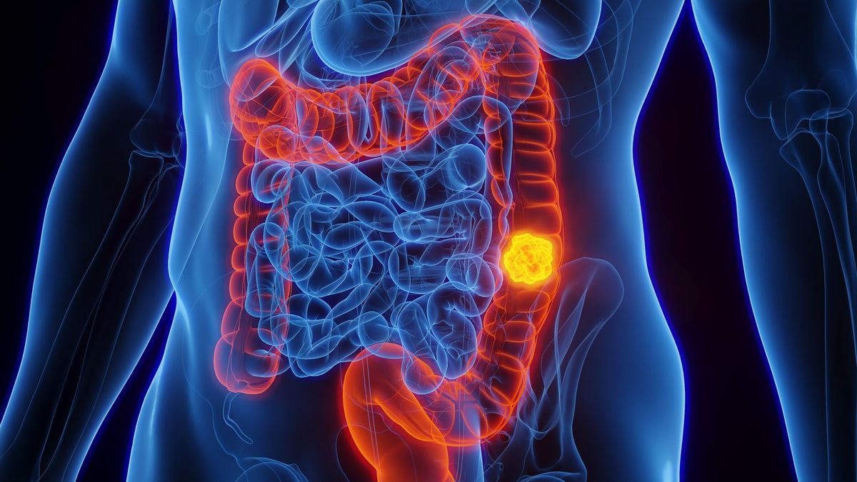 The Foods 80% of One Oncologist’s Colon Cancer Patients Ate
